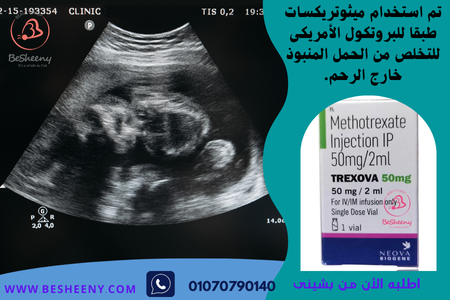 ميثوتريكست فيال لاجهاض الحمل المنبوذ من الرحم METHOTREXATE 50 mg