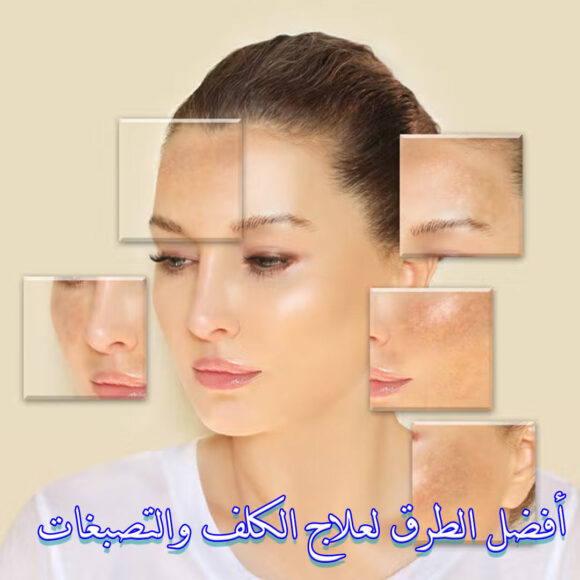 أفضل الطرق لعلاج الكلف والتصبغات