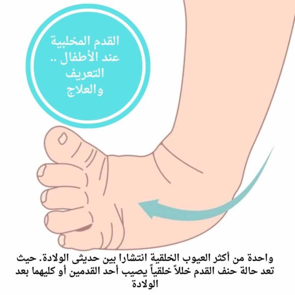 القدم المخلبية عند الأطفال .. التعريف والعلاج