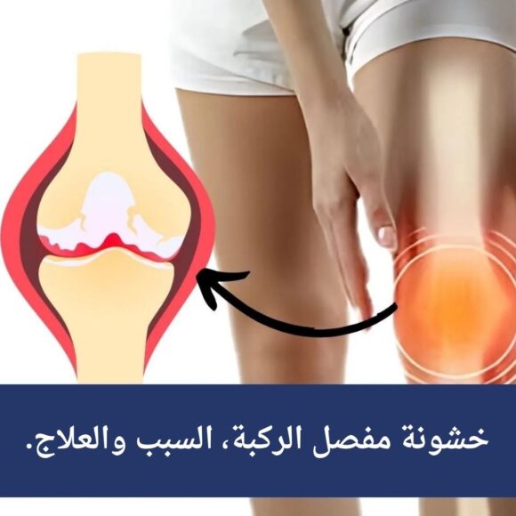 خشونة مفصل الركبة، السبب والعلاج.