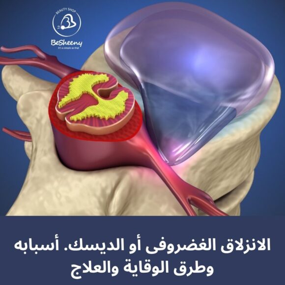 الانزلاق الغضروفى أو الديسك.أسبابه وطرق الوقاية والعلاج