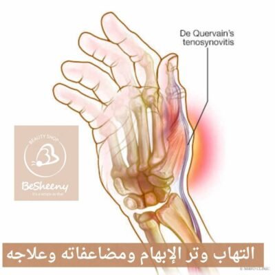 التهاب وتر الإبهام ومضاعفاته وعلاجه