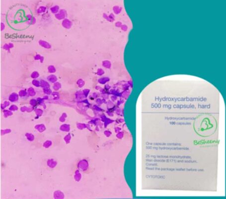 هيدروكسي يوريا الإنجليزي Hydroxyurea والدورة الدموية