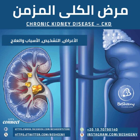 مرض الكلى المزمن - الأعراض والأسباب والعلاج