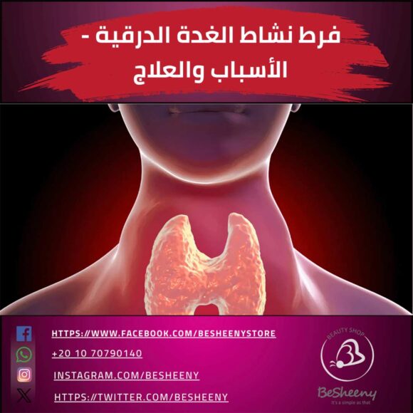 فرط نشاط الغدة الدرقية - الأسباب والعلاج