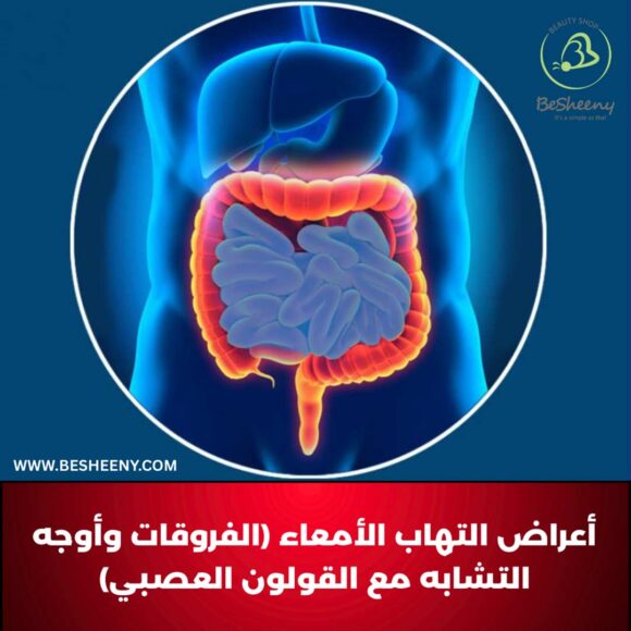 أعراض التهاب الأمعاء (الفروقات وأوجه التشابه مع القولون العصبي)