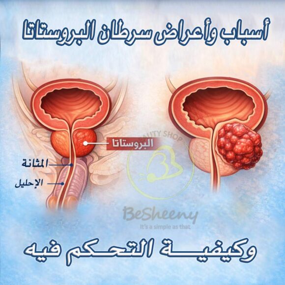أسباب وأعراض سرطان البروستاتا