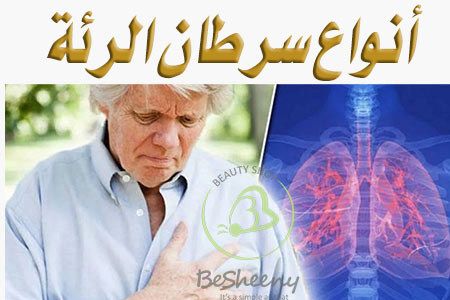 ينقسم إلى نوعين صغير الخلايا وغير صغير الخلايا