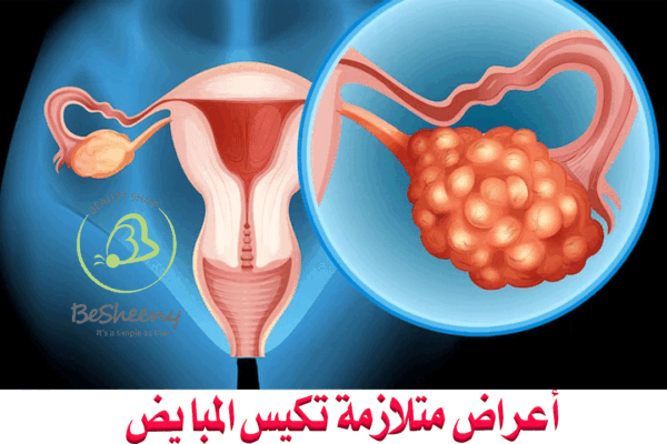 تختلف أعراض تكيس المبايض من امرأة لأخرى،