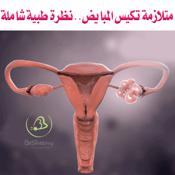 متلازمة تكيس المبايض ..نظرة طبية شاملة