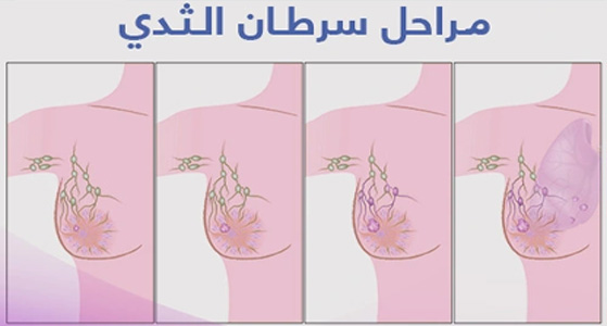 مراحل تطور سرطان الثدي