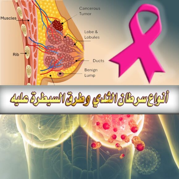 أنواع سرطان الثدي، وطرق السيطرة عليه