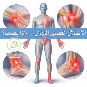 الاعتلالات العصبية البؤرية هي حالات يحدث فيها تلف لعصب واحد غالبا. ويكون ذلك في العادة في اليد أو الرأس كذلك الجذع أو الساق.