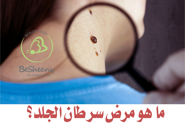 هو نوع من السرطان يبدأ كنمو غير طبيعي للخلايا في الجلد