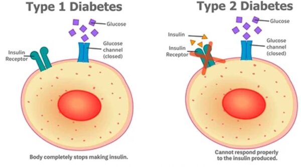 أسباب وأعراض مرض السكري، الأنواع