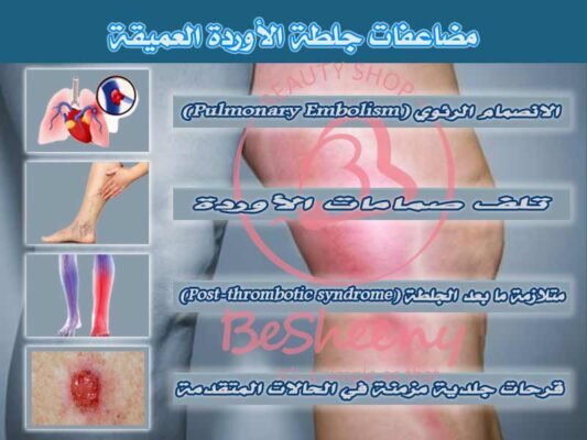 مضاعفات جلطة الأوردة العميقة