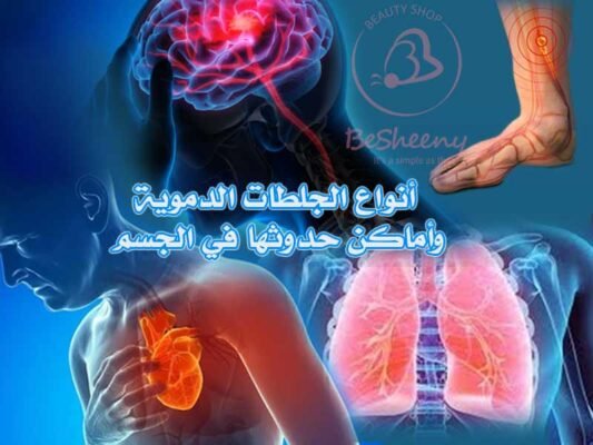 أنواع الجلطات الدموية وأماكن حدوثها في الجسم
