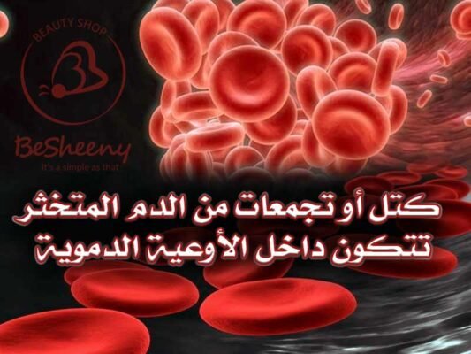 ما هي الجلطة الدموية وكيف تتكون؟