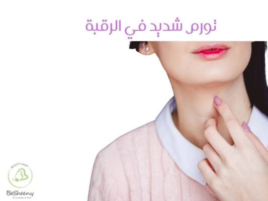 تورم شديد في الرقبة
