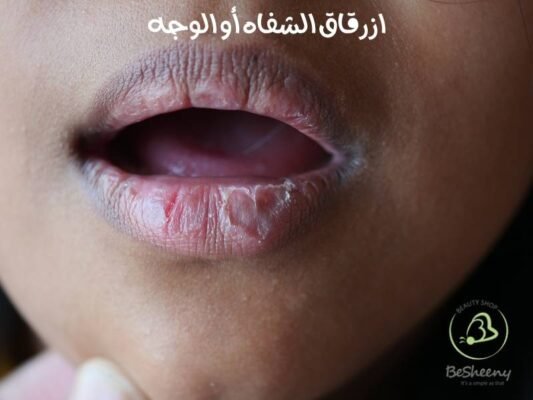 ازرقاق الشفاه أو الوجه