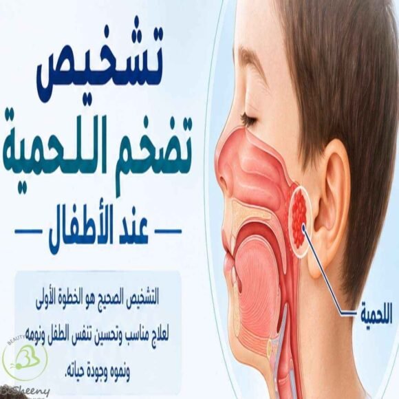 تشخيص اللحمية