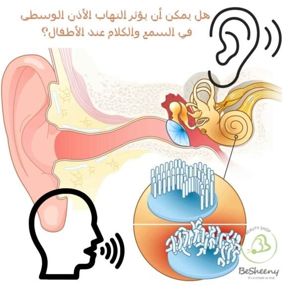 هل يمكن أن يؤثر التهاب الأذن الوسطى في السمع والكلام عند الأطفال؟
