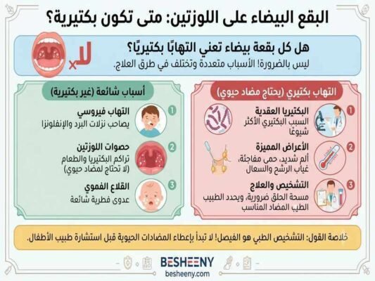 البقع البيضاء علي اللوزتين متي تكون بكترية
