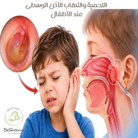 اللحمية والتهاب الأذن الوسطى عند الأطفال
