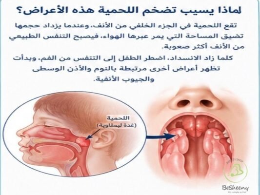 اعراض اللحمية