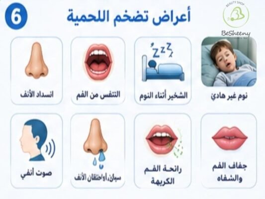 اعراض تضخم اللحمية