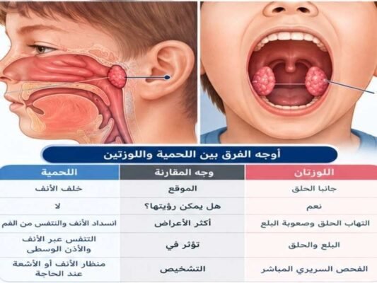 الفرق بين اللحمية واللوزتان