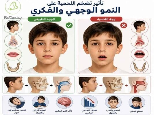 تأثير تضخم اللحمية علي الوجه