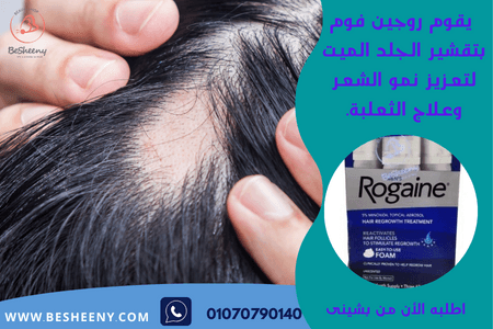 رغوة روجين الأمريكية للرجال للمساعدة في الحد من الثعلبة