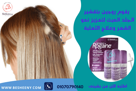 روجين للنساء لدعم الحالات الخاصة بمشكلة الثعلبة