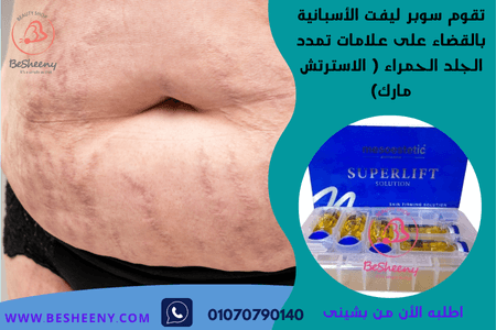  لتحسين مظهر علامات التمدد الحمراء – Superlift